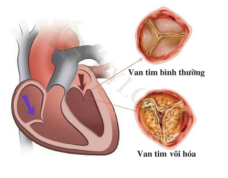 Hình ảnh van tim bị vôi hóa.